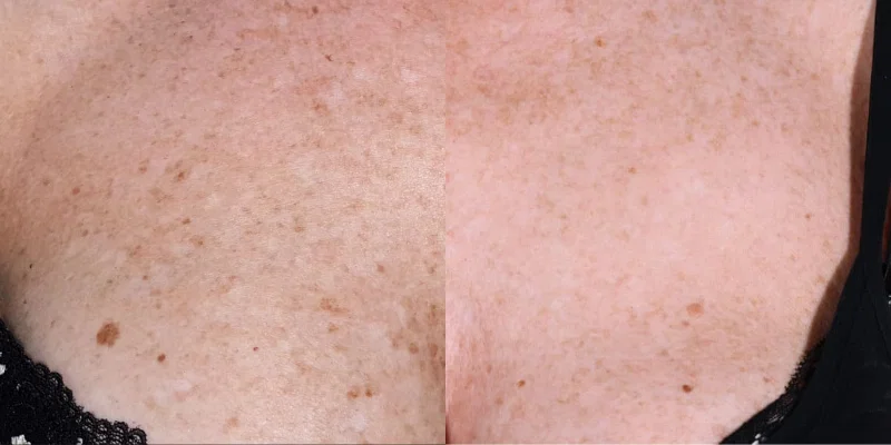 Odstranjevanje pigmentnih madežev: Metode in rezultati