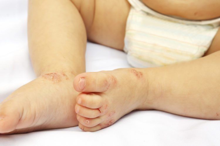 Na pohodu je bolezen rok, nog in ust