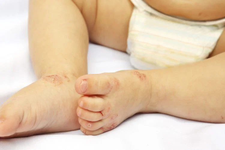 Na pohodu je bolezen rok, nog in ust