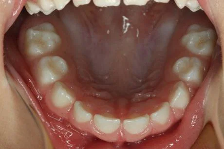 Ste vedeli? Sladke pijače uničujejo otroške nasmehe (FOTO)