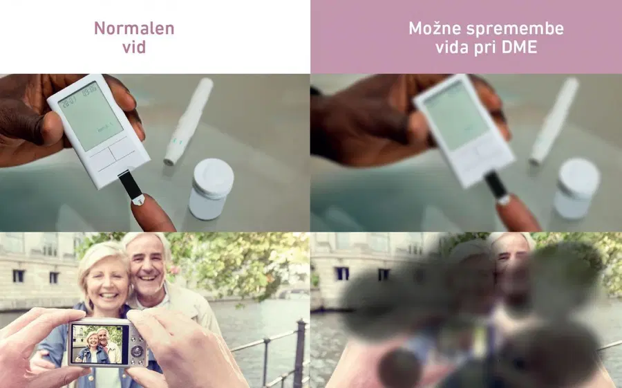 Ste vedeli, da je vid sladkornih bolnikov bolj ogrožen?