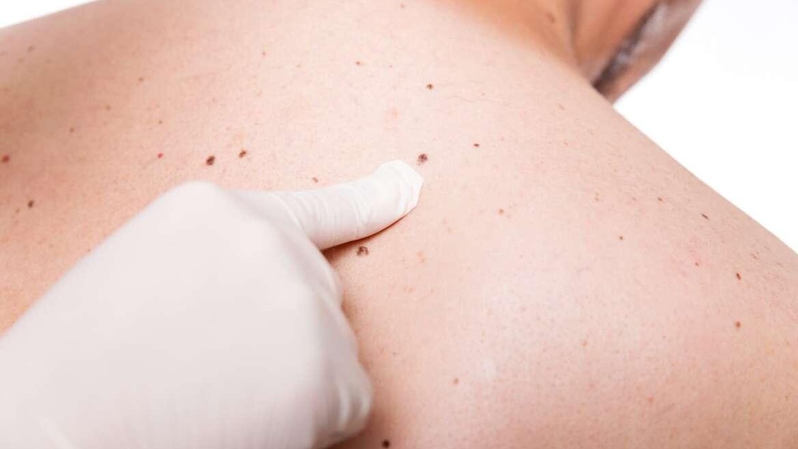 Dermatološki pregled: kdaj ga nujno potrebujete?