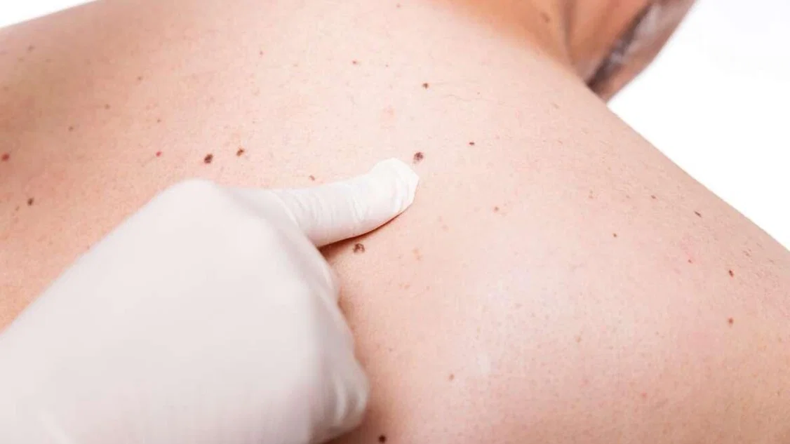 Dermatološki pregled: kdaj ga nujno potrebujete?